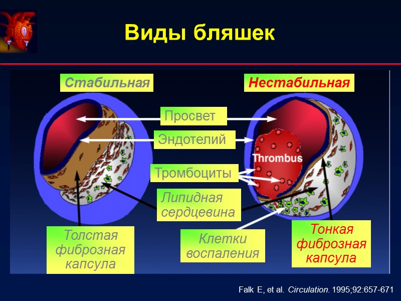 Виды бляшек Falk E, et al. Circulation. 1995;92:657-671 Стабильная Нестабильная Толстая Виды бляшек Falk E, et al. Circulation. 1995;92:657-671 Стабильная Нестабильная Толстая